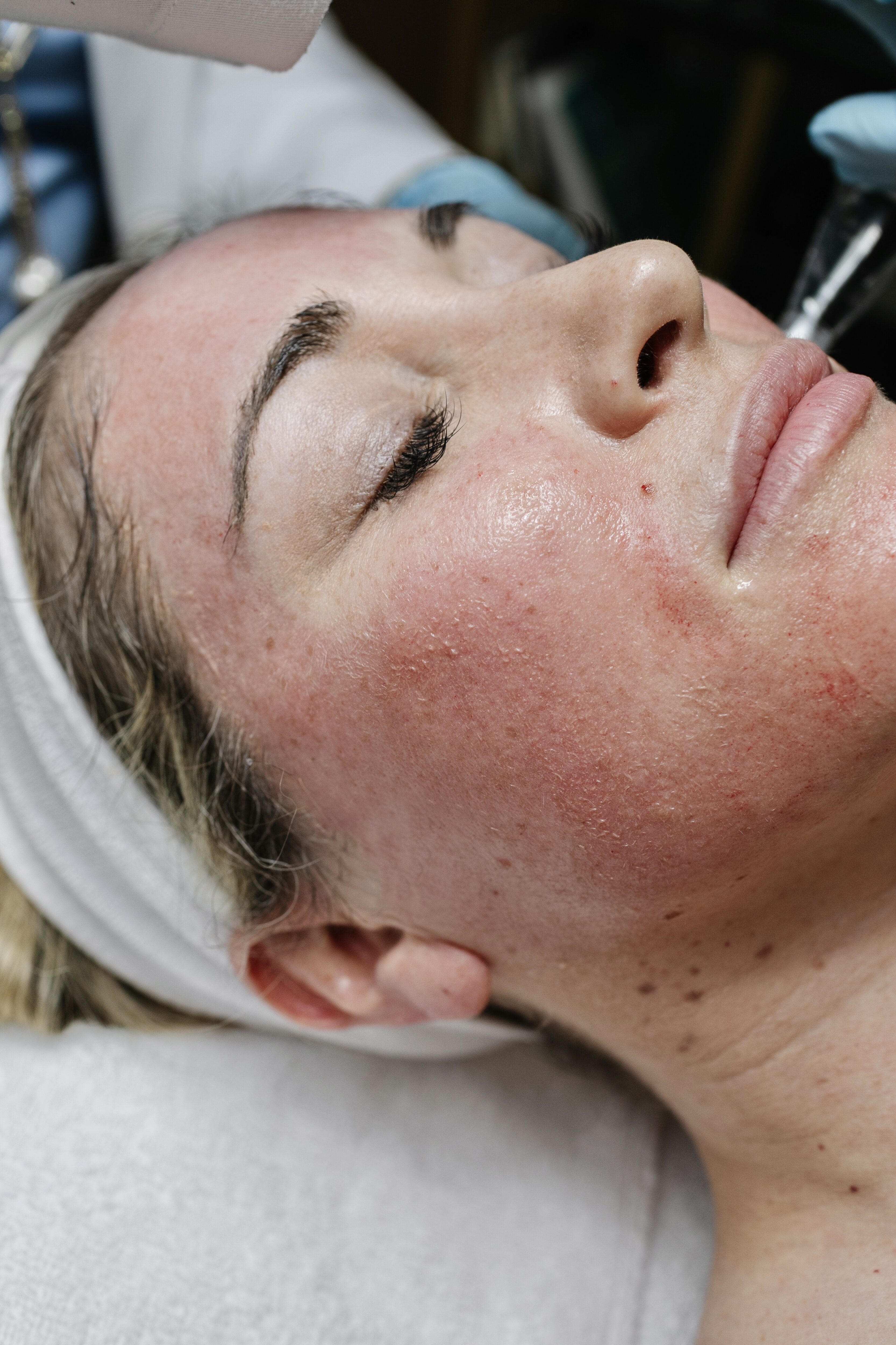 microneedling process